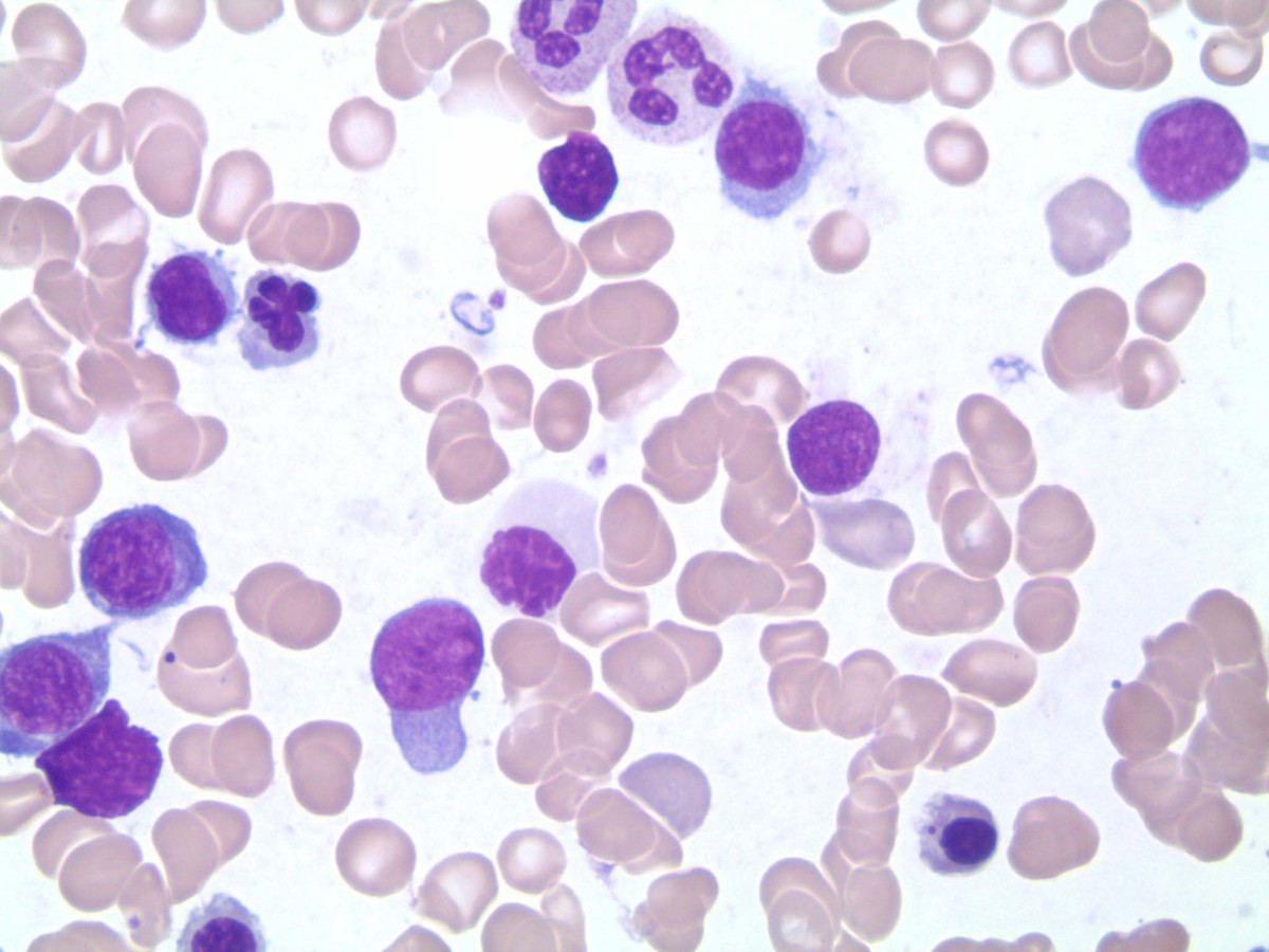 Smear with dyserythropoiesis 1000x